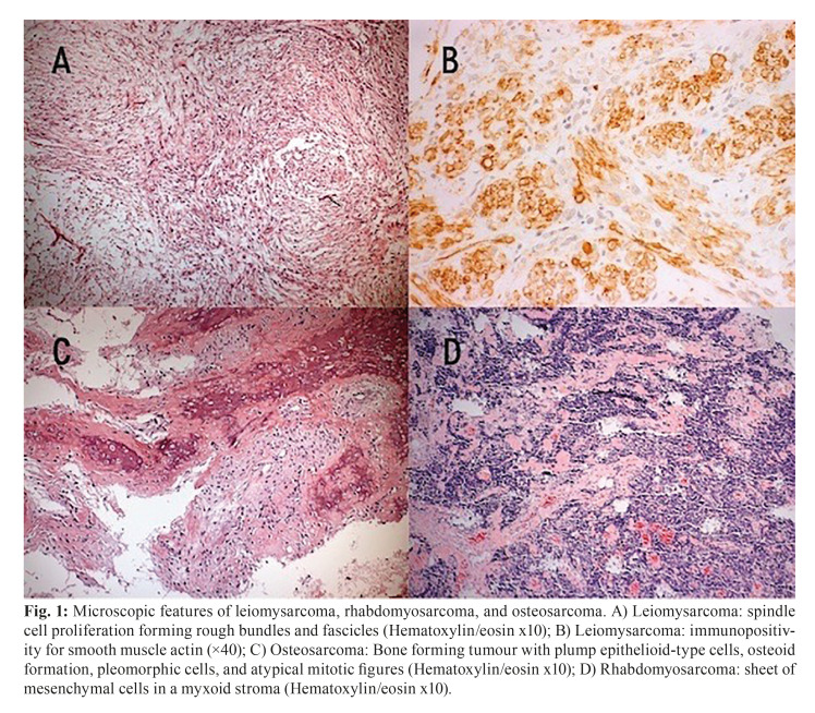 Paediatric head and neck malignant neoplasms: A brazilian retrospective study.