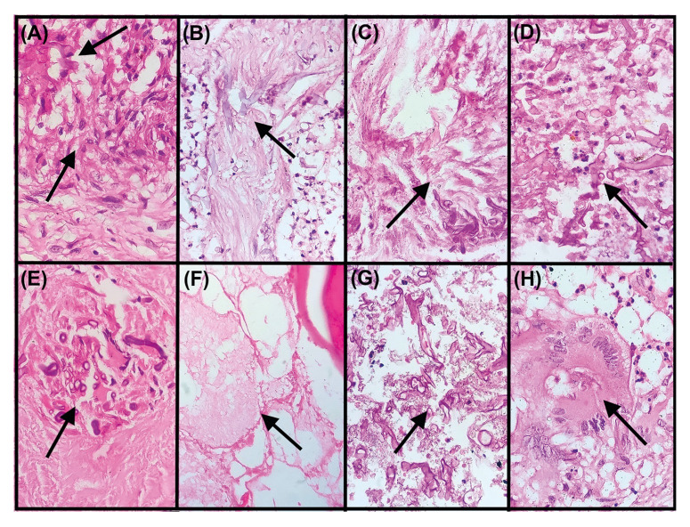 Mucormycosis infection associated with global COVID-19 pandemic - an institutional histopathological study.