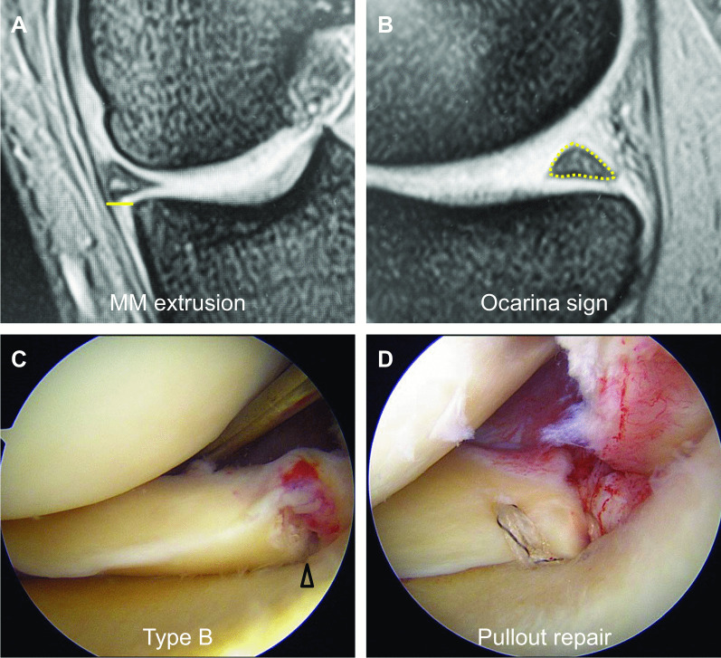 Meniscus extrusion is a predisposing factor for determining arthroscopic treatments in partial medial meniscus posterior root tears.