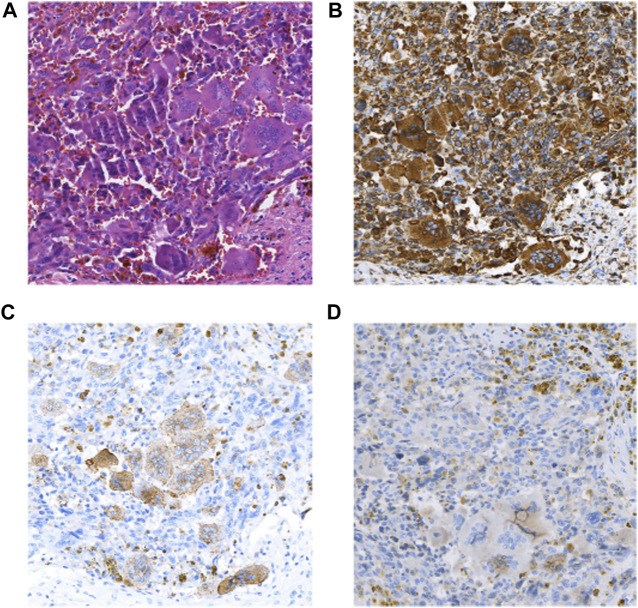 Case report: Pathological and genetic features of pancreatic undifferentiated carcinoma with osteoclast-like giant cells.