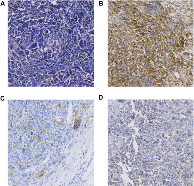 Case report: Pathological and genetic features of pancreatic undifferentiated carcinoma with osteoclast-like giant cells.