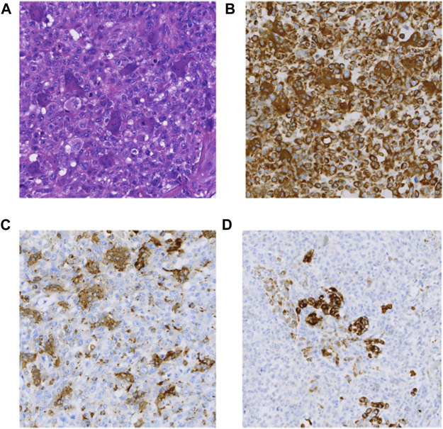 Case report: Pathological and genetic features of pancreatic undifferentiated carcinoma with osteoclast-like giant cells.