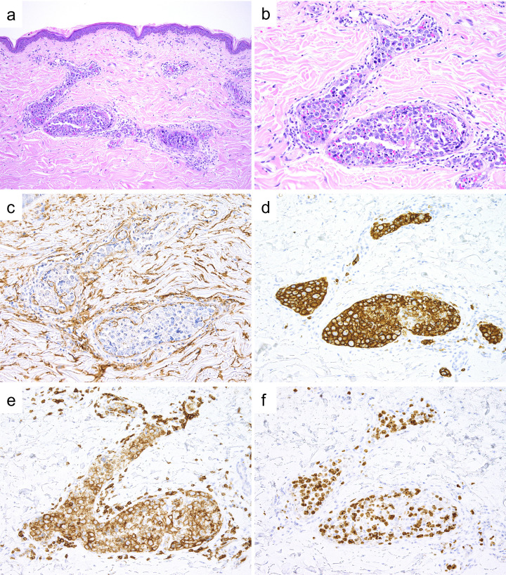 Comparison of serum sIL-2R and LDH levels in patients with intravascular large B-cell lymphoma and patients with advanced stage diffuse large B-cell lymphoma.