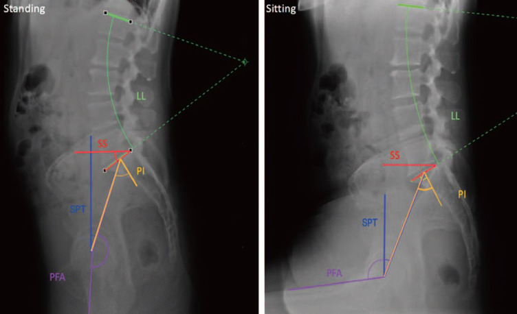 Relationship between Spinopelvic Parameters and Hip Function in Patients with Femoroacetabular Impingement at Diagnosis: A Cross-Sectional Study.