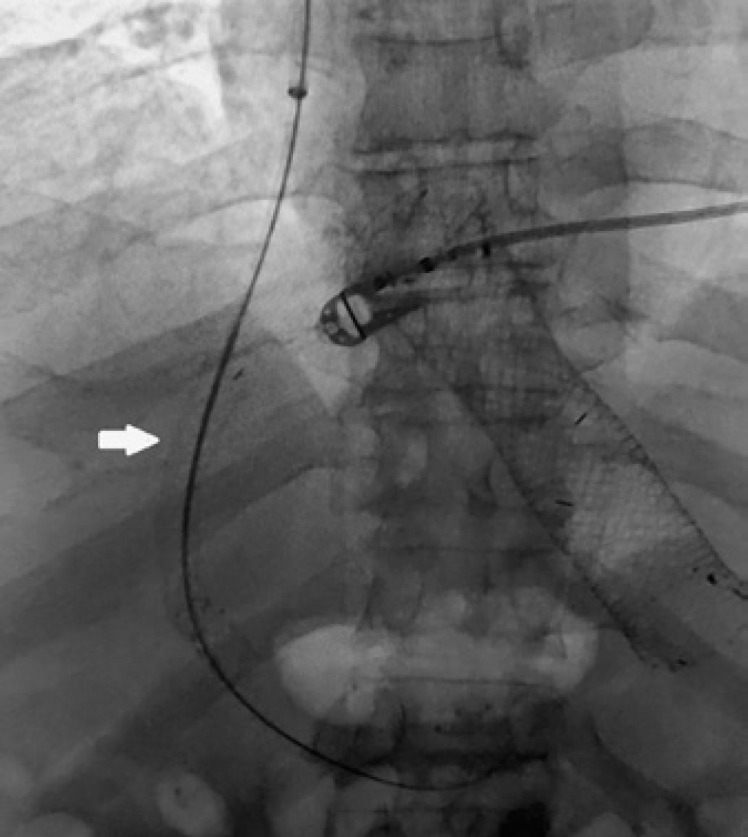 SX-ELLA Danis-Stent for Refractory Acute Esophageal Variceal Bleeding.