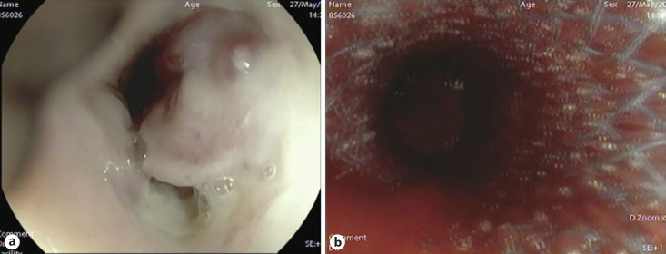 SX-ELLA Danis-Stent for Refractory Acute Esophageal Variceal Bleeding.