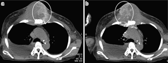 A Case of Bilateral Internal Mammary Arterial Infusion Chemotherapy Using Implantable Port-catheter Systems for Anterior Chest Wall Metastasis of Breast Cancer.