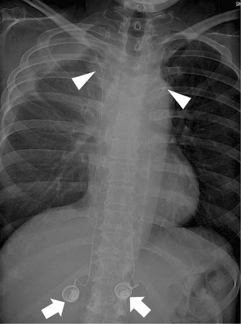 A Case of Bilateral Internal Mammary Arterial Infusion Chemotherapy Using Implantable Port-catheter Systems for Anterior Chest Wall Metastasis of Breast Cancer.