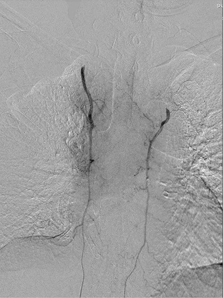 A Case of Bilateral Internal Mammary Arterial Infusion Chemotherapy Using Implantable Port-catheter Systems for Anterior Chest Wall Metastasis of Breast Cancer.