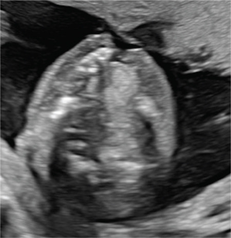 The impact of developmental genes in non-syndromic cleft lip and/or palate