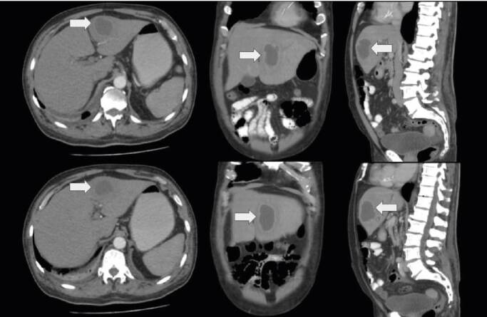 Liver abscess due to Granulicatella adiacens in an immunocompetent patient: Case report.