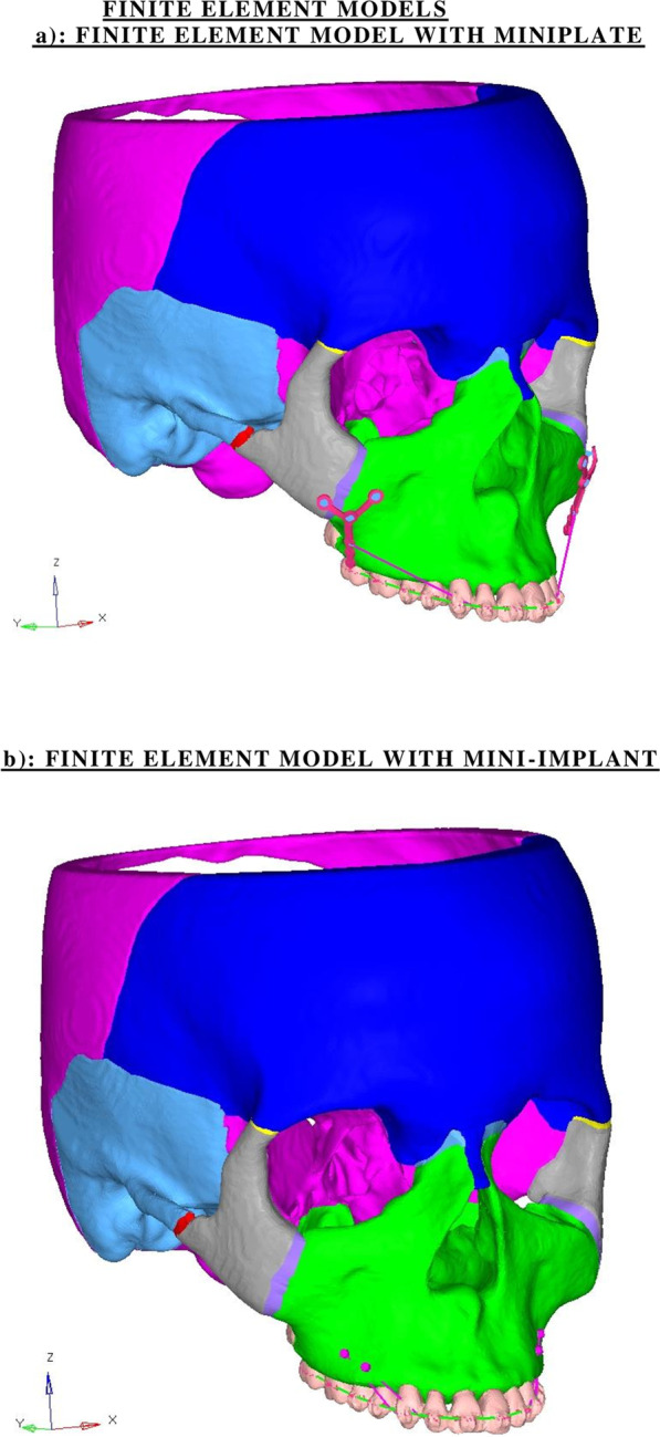 Stress distribution and displacement in the maxillofacial complex during intrusion and distalization of the maxillary arch using miniplates versus mini-implants: a 3-dimensional finite element study.