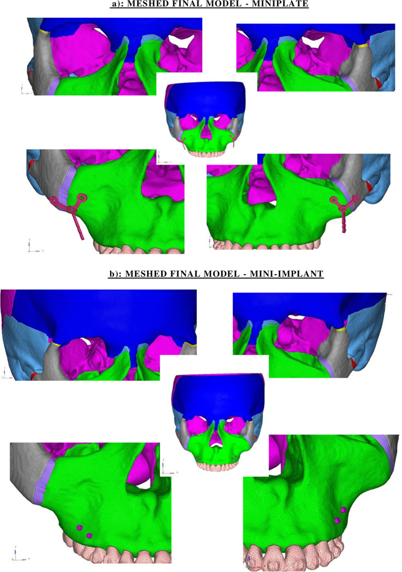 Stress distribution and displacement in the maxillofacial complex during intrusion and distalization of the maxillary arch using miniplates versus mini-implants: a 3-dimensional finite element study.