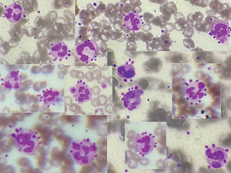 Platelets-Leucocyte Satellitism: Love Is in the EDTA!