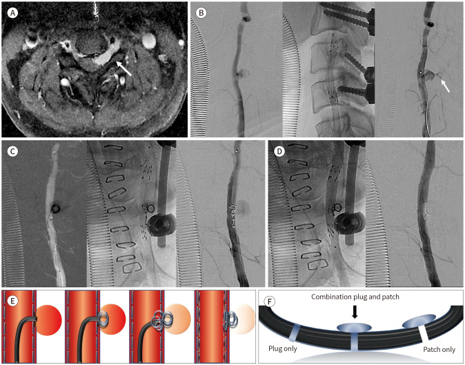 Endovascular Management of Iatrogenic Vertebral Artery Pseudoaneurysm: A Case Report.