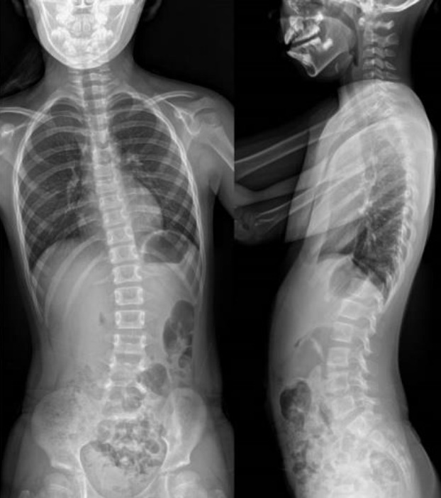 First female Korean child with Coffin-Lowry syndrome: a novel variant in RPS6KA3 diagnosed by exome sequencing and a literature review.