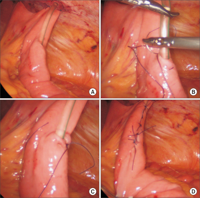 Laparoscopic Witzel feeding jejunostomy: a procedure overlooked!