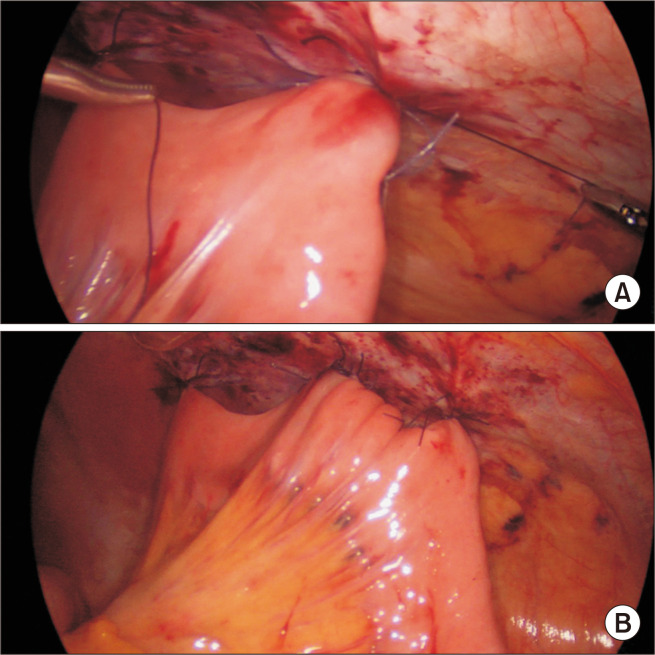 Laparoscopic Witzel feeding jejunostomy: a procedure overlooked!