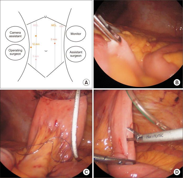 Laparoscopic Witzel feeding jejunostomy: a procedure overlooked!