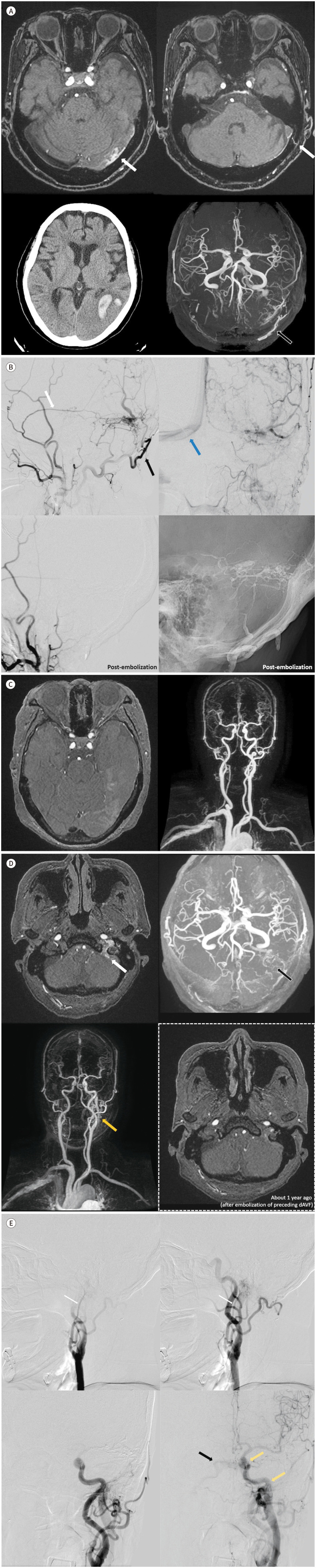 Occurrence of Metachronous Intracranial Dural Arteriovenous Fistula after Embolization of Intracranial Dural Arteriovenous Fistula: A Case Report.