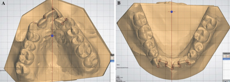 Incisor irregularity and dental arch dimensions changes in subjects with different severity of anterior crowding: a 37-year follow-up.