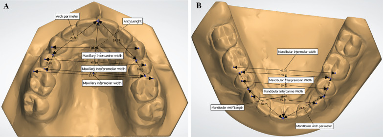 Incisor irregularity and dental arch dimensions changes in subjects with different severity of anterior crowding: a 37-year follow-up.