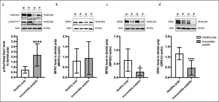 Observation of Inflammation, Oxidative Stress, Mitochondrial Dynamics, and Apoptosis in Dental Pulp following a Diagnosis of Irreversible Pulpitis.