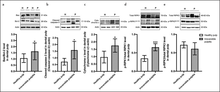 Observation of Inflammation, Oxidative Stress, Mitochondrial Dynamics, and Apoptosis in Dental Pulp following a Diagnosis of Irreversible Pulpitis.