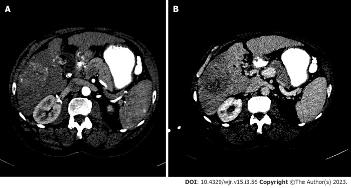 Hepatocellular carcinoma: State of the art diagnostic imaging.