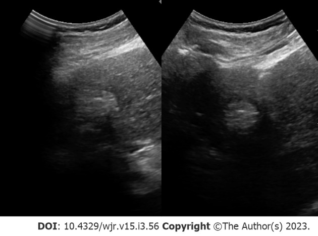 Hepatocellular carcinoma: State of the art diagnostic imaging.