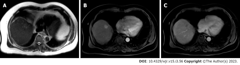 Hepatocellular carcinoma: State of the art diagnostic imaging.