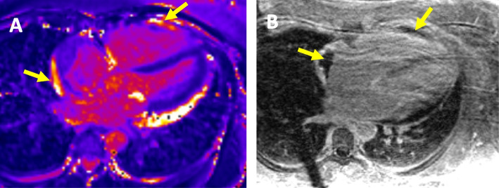 Refractory right ventricular myocarditis induced by immune checkpoint inhibitor despite therapy cessation and immune suppression.