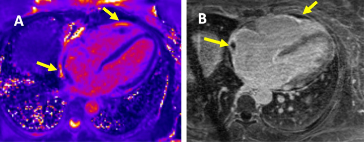 Refractory right ventricular myocarditis induced by immune checkpoint inhibitor despite therapy cessation and immune suppression.