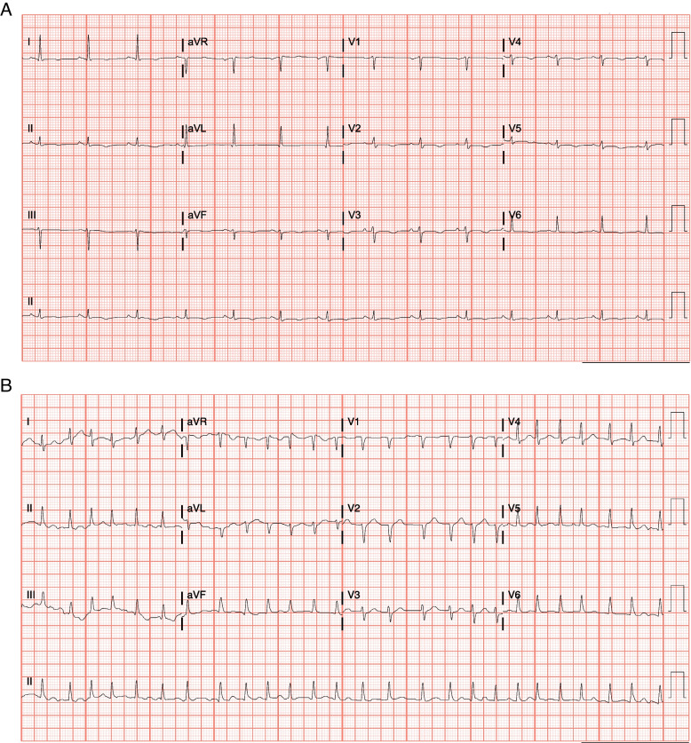 Refractory right ventricular myocarditis induced by immune checkpoint inhibitor despite therapy cessation and immune suppression.