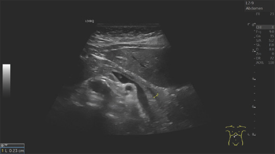 Pancreatic duct imaging during aging.