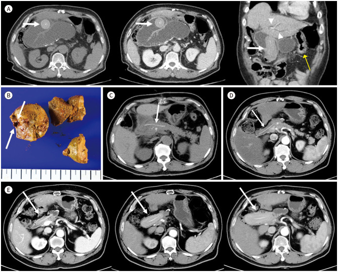 Migrated Pancreaticojejunal Stent Forming a Stent-Stone Complex in the Jejunum with Resultant Small Bowel Obstruction: A Case Report.