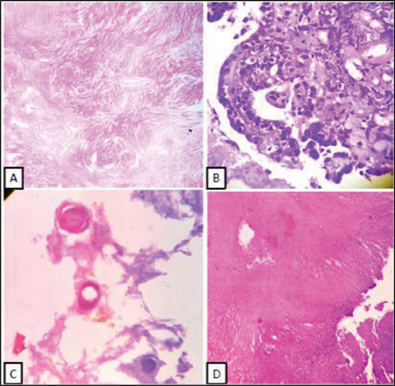 Histopathological Profile of Central Nervous System Tumors in a Peripheral Tertiary Care Centre of West Bengal.