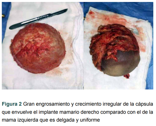 [Autoimmune/inflammatory syndrome induced by adjuvants. Case report].