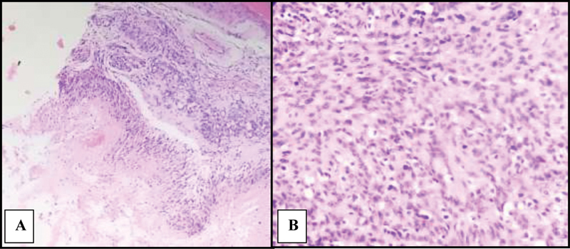 Histopathological Profile of Central Nervous System Tumors in a Peripheral Tertiary Care Centre of West Bengal.