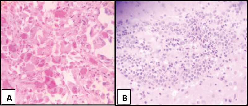 Histopathological Profile of Central Nervous System Tumors in a Peripheral Tertiary Care Centre of West Bengal.