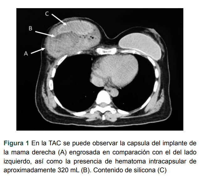 [Autoimmune/inflammatory syndrome induced by adjuvants. Case report].