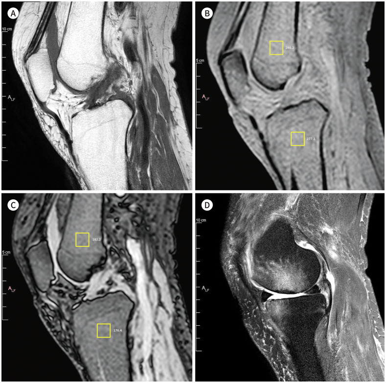 [Correlation Analysis between Fat Fraction and Bone Mineral Density Using the DIXON Method for Fat Dominant Tissue in Knee Joint MRI: A Preliminary Study].