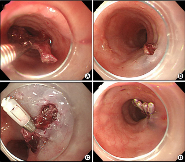 Prediction of Severity and Adverse Outcomes Associated with Perforation in Patients Presenting to the Emergency Department with Esophageal Injury.