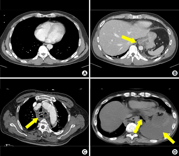 Prediction of Severity and Adverse Outcomes Associated with Perforation in Patients Presenting to the Emergency Department with Esophageal Injury.