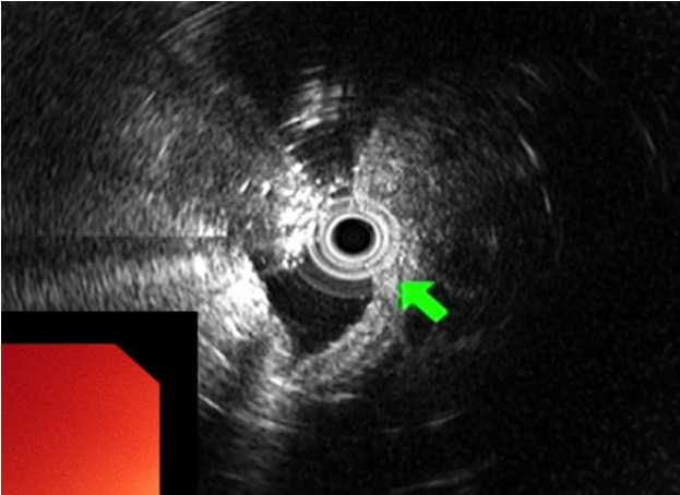 [Gastric Inverted Hyperplastic Polyp Removed Using Endoscopic Submucosal Dissection].