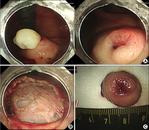 [Gastric Inverted Hyperplastic Polyp Removed Using Endoscopic Submucosal Dissection].