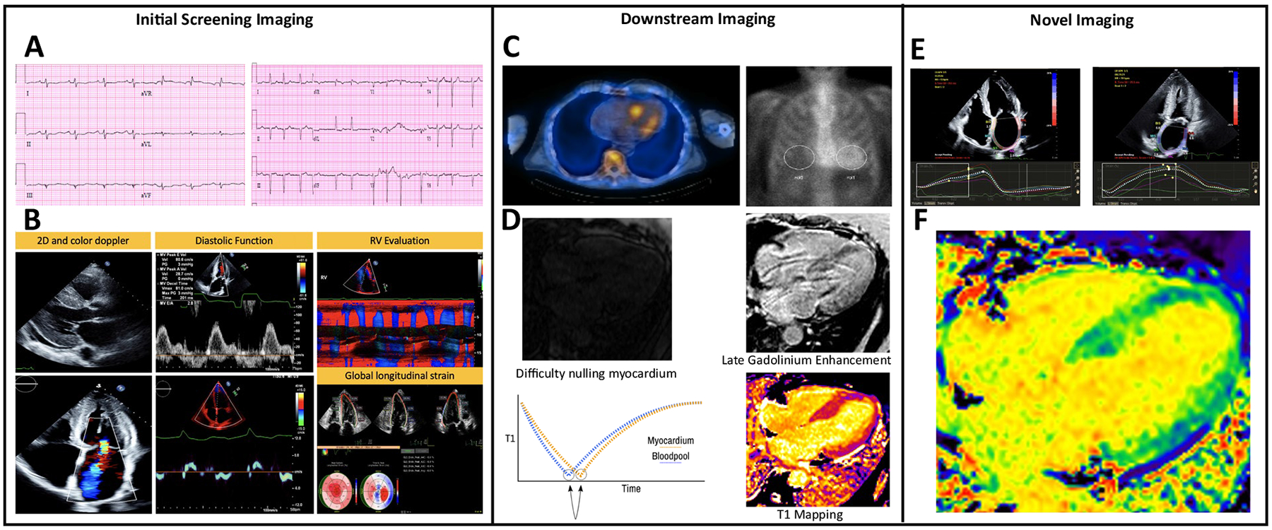 A Review of Current and Evolving Imaging Techniques in Cardiac Amyloidosis.