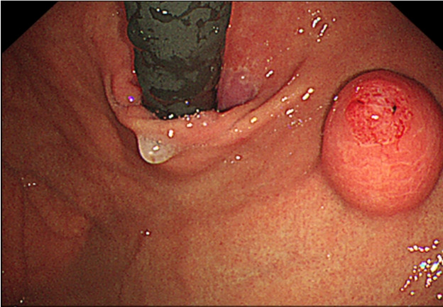 [Gastric Inverted Hyperplastic Polyp Removed Using Endoscopic Submucosal Dissection].