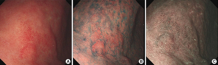 [Approach to Patients after Successful Eradication of <i>Helicobacter pylori</i>].