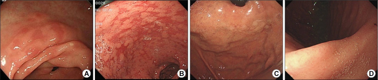 [Approach to Patients after Successful Eradication of <i>Helicobacter pylori</i>].